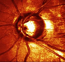 HRT-Bild eines Sehnervenkopfes bei einem Patienten mit fortgeschrittenem Grünem Star (Glaukom)