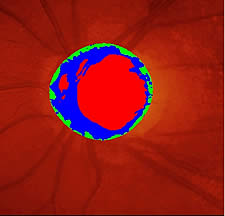 Digitale Berechnung der Fläche der Aushöhlung des Sehnervenkopfes (rotes Areal) zur Beurteilung des Fortschreitens der Erkrankung