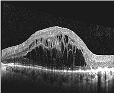 OCT-Bild der Makula eines Patienten mit großen flüssigkeitsgefüllten Zysten im Bereich der Stelle des schärfsten Sehens der Netzhaut