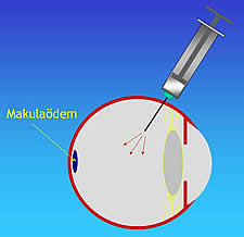 Schema einer intraokularen Injektion