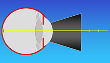 Schematische Darstellung einer Lasertherapie am Augenhintergrund