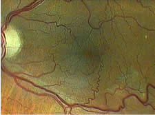 Fotographie desselben Augenhintergrundes nach der chirurgischen Entfernung der Membran