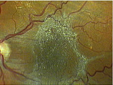 Fotographie eines Augenhintergrundes mit einer Membran über der Stelle des schärfsten Sehens (Makula Pucker) vor dem operativen Eingriff.