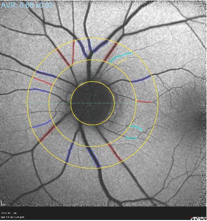 Auswertung der Messung der Gefäßkaliber bei einem Patienten.