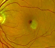 RETIVASC – Retinale Metastase Bei Lungenkarzinom